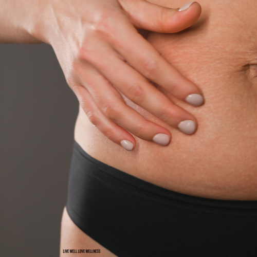 How to Avoid Stretch Marks in Pregnancy